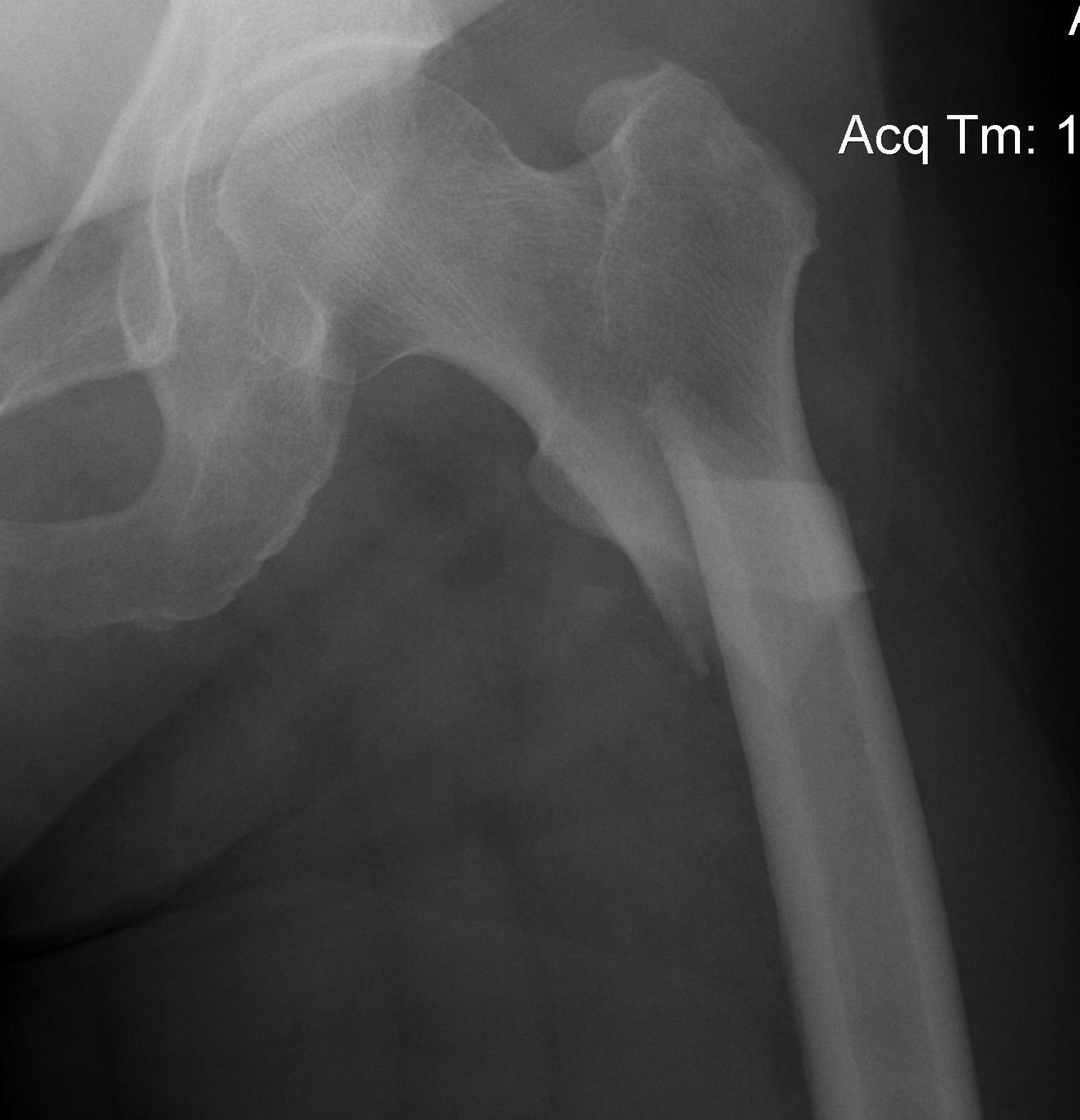 Subtrochanteri Fracture